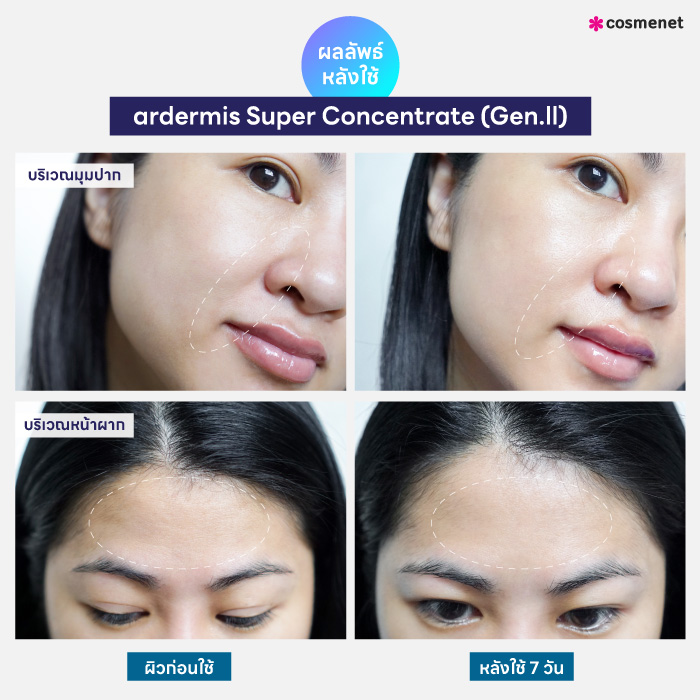 เซรั่ม ardermis Super Concentrate (Gen.ll)