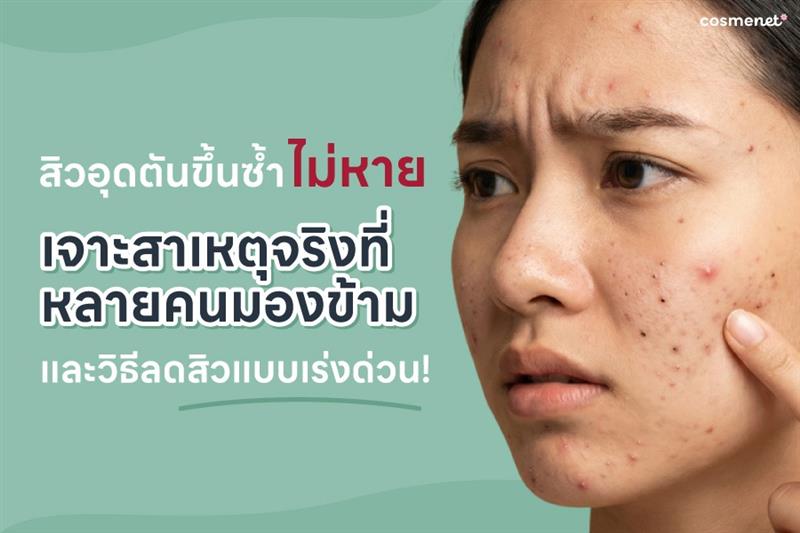 สิวอุดตันขึ้นซ้ำไม่หาย สาเหตุจริงที่หลายคนมองข้าม และวิธีลดสิวแบบเร่งด่วน