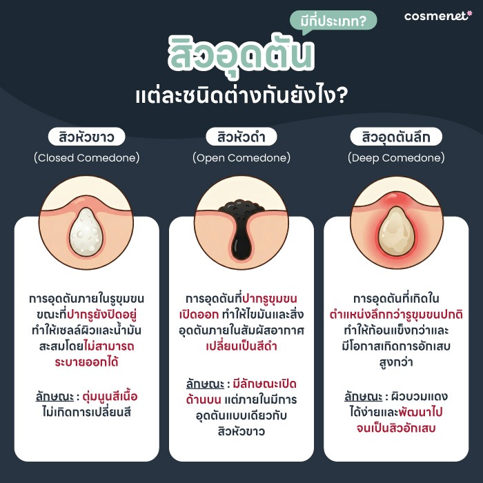 สิวอุดตันขึ้นซ้ำไม่หาย สาเหตุจริงที่หลายคนมองข้าม และวิธีลดสิวแบบเร่งด่วน