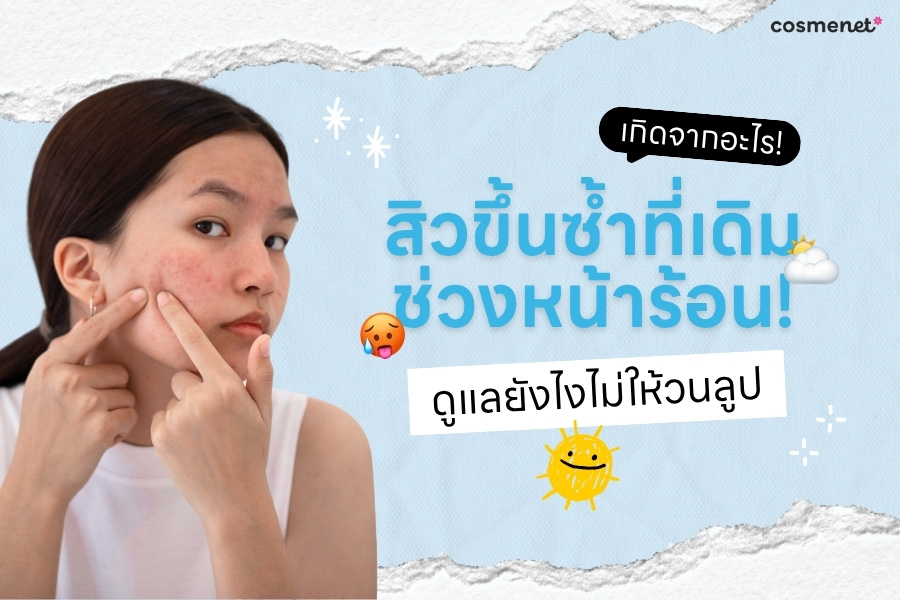 สิวขึ้นซ้ำที่เดิมช่วงหน้าร้อน! เกิดจากอะไร ดูแลยังไงไม่ให้วนลูป
