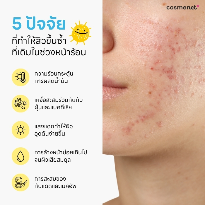 5 ปัจจัยที่ทำให้เกิดสิวขึ้นซ้ำซาก ในช่วงหน้าร้อน
