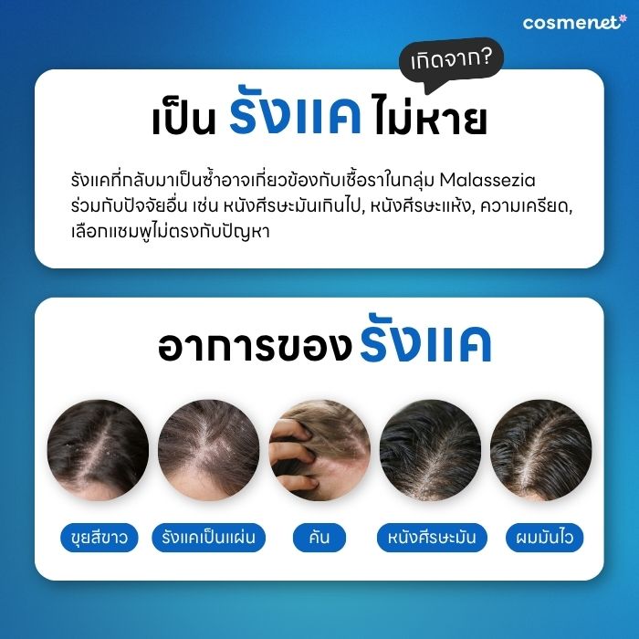 เป็นรังแคไม่หาย เกิดจากอะไร