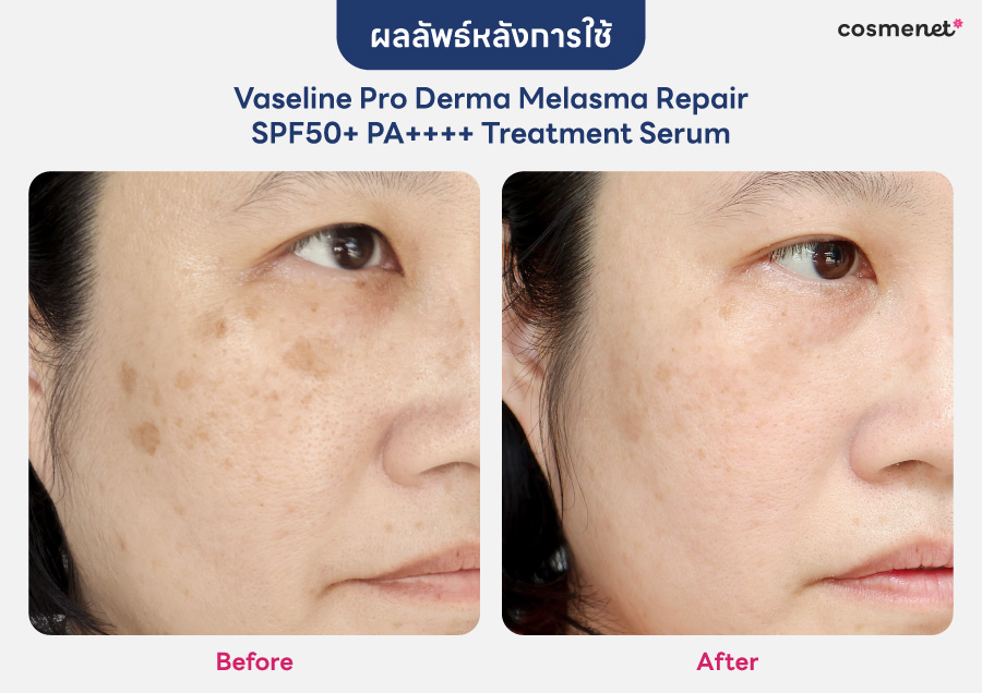 รีวิว Vaseline Pro Derma Melasma Repair SPF50+ PA++++ Treatment Serum มาพร้อม ไกลโคโซม™ เทคโนโลยีจัดการฝ้าแดดและจุดด่างดำที่ทรงพลังและใหม่ที่สุดในโลกจากวาสลีน รีวิวผลลัพธ์หลังใช้ Vaseline Pro Derma Melasma Repair SPF50+ PA++++ Treatment Serum