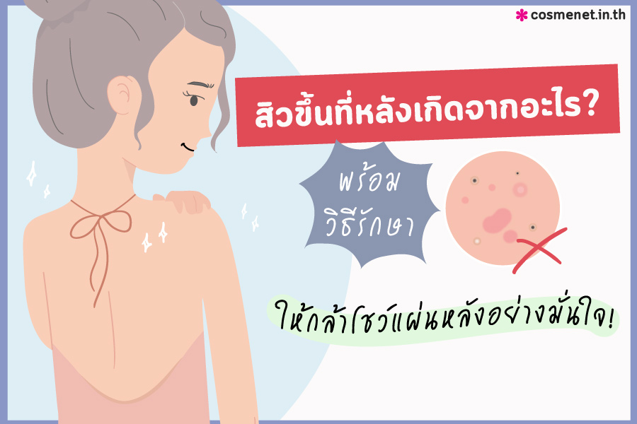 รักษาสิวที่หลัง