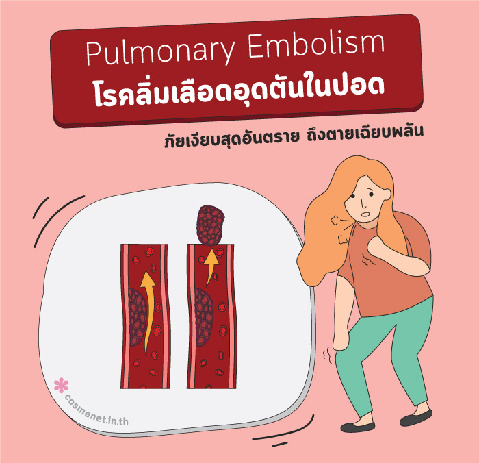 โรคลิ่มเลือดอุดตันในปอด Pulmonary Embolism