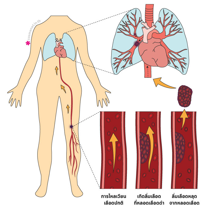 โรคลิ่มเลือดอุดตันในปอด อาการ