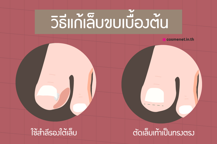 การป้องกันและการรักษาเล็บขบ