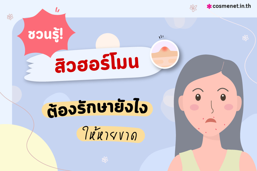 สิวฮอร์โมน รักษายังไง