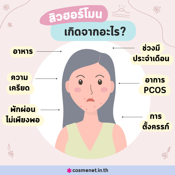 สิวฮอร์โมน เกิดจากอะไร