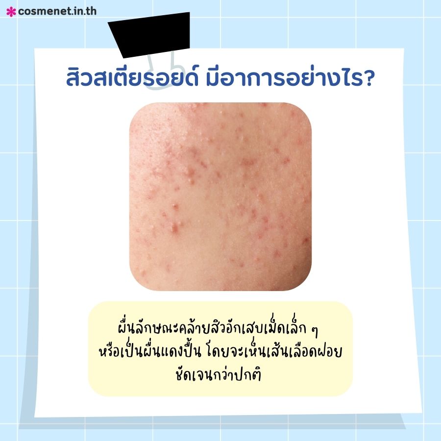 สิวสเตียรอยด์ มีอาการอย่างไร?