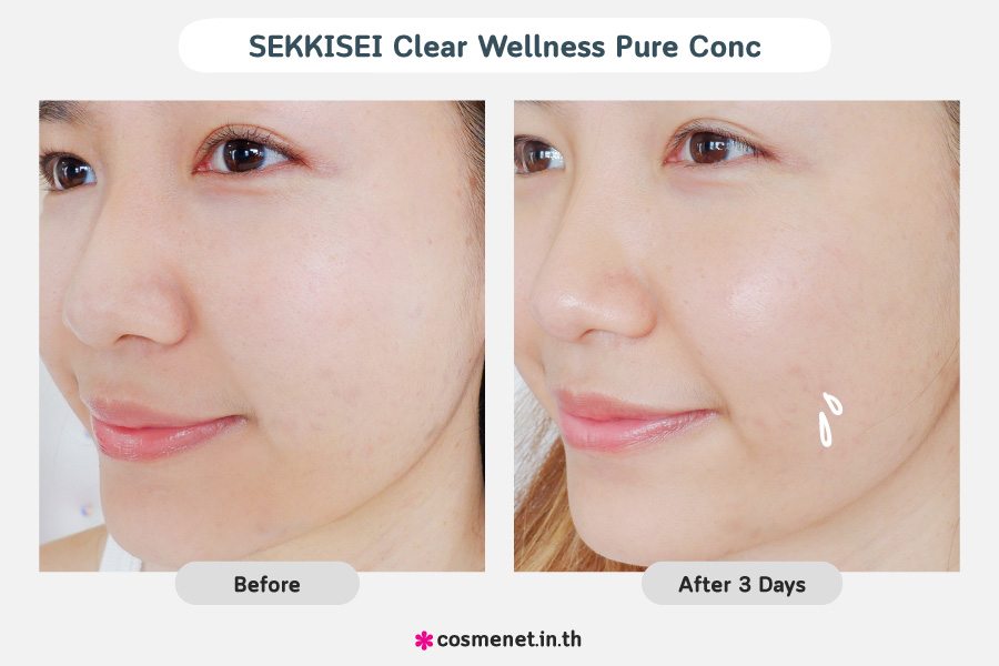 รีวิวผลลัพธ์หลังการใช้ SEKKISEI CLEAR WELLNESS Pure Conc