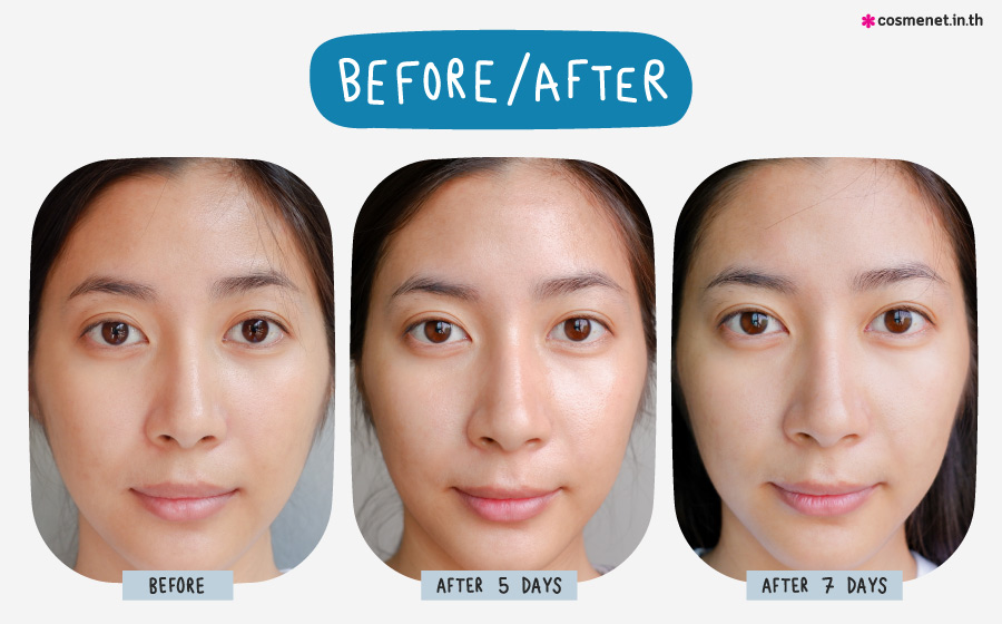 before after หลังทาเซรั่ม vichy mineral 89