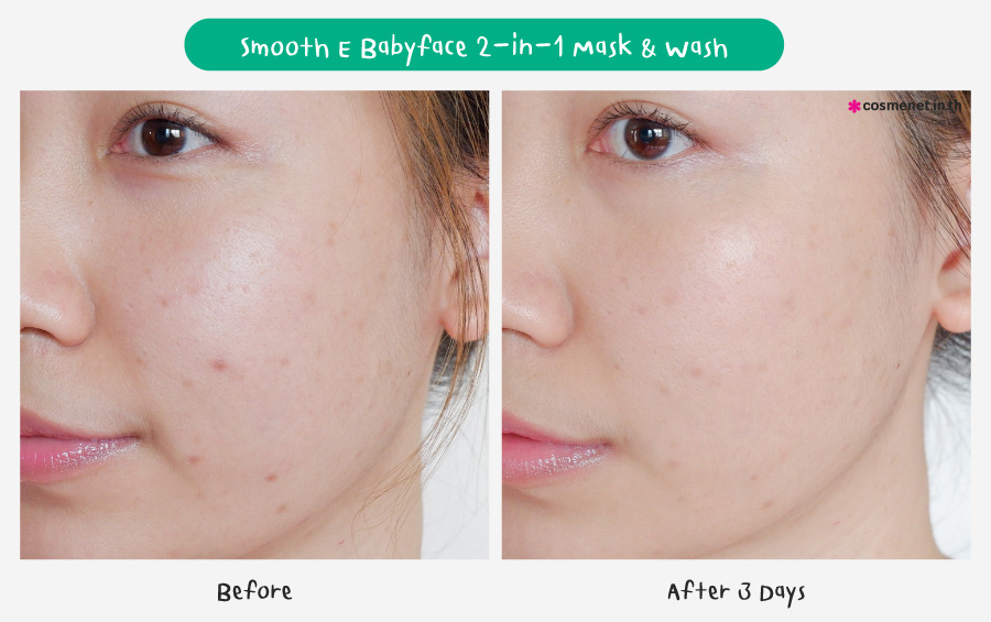 หลังใช้ Smooth E 2-in-1 Mask & Wash  3 วัน