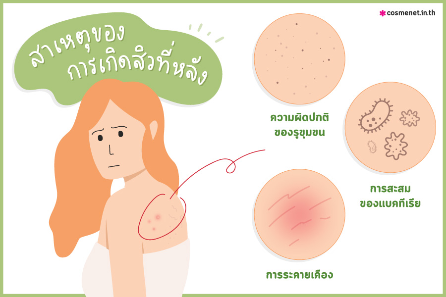 3 สาเหตุของการเกิดสิวที่หลัง