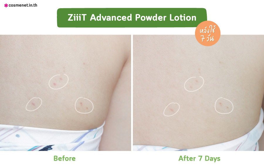 รีวิวก่อนและหลังใช้ ZiiiT Advanced Powder Lotion