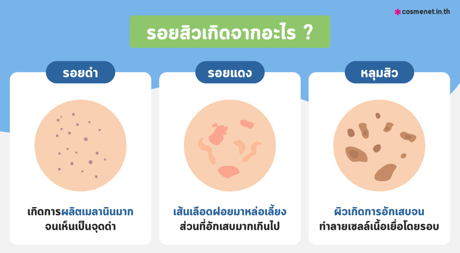 รอยสิวเกิดจากอะไร