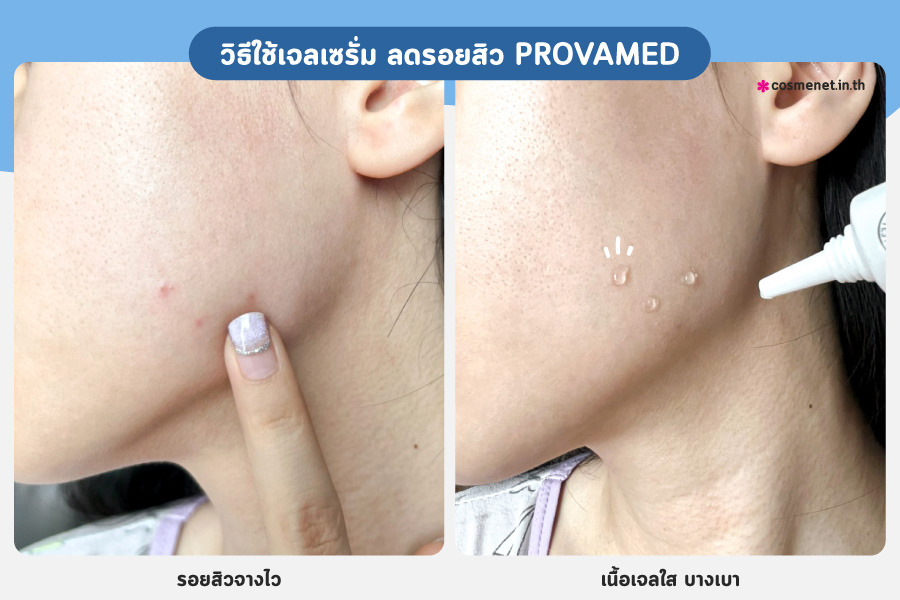 เซรั่มลดรอยสิว Provamed Post Acne Scar Gel