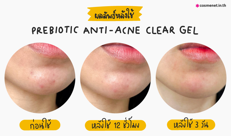 CURA-MD Prebiotic Anti-Acne Clear Gel เจลแต้มสิว