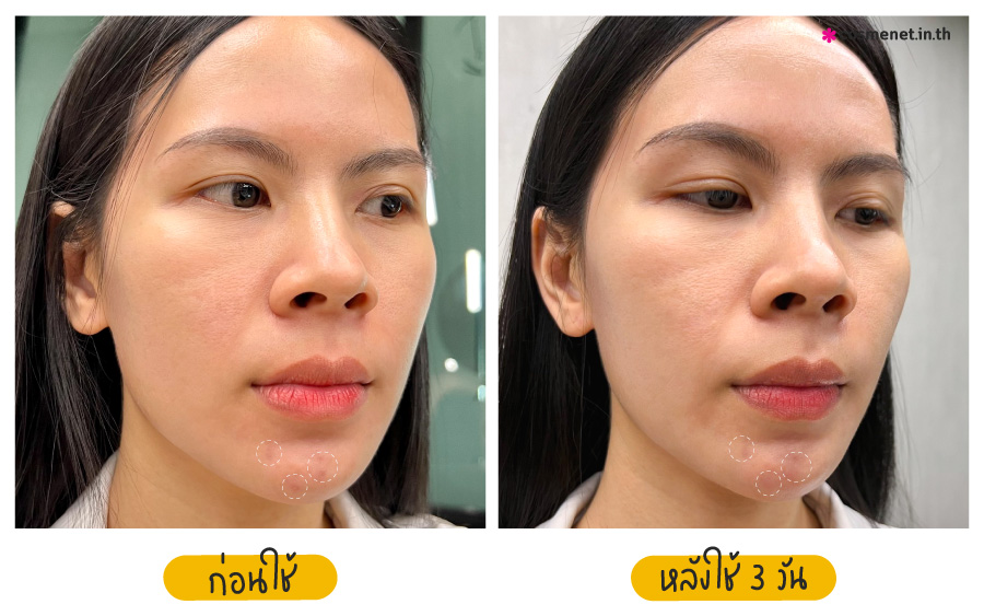 เจลแต้มสิว CURA-MD Prebiotic Anti-Acne Clear Gel