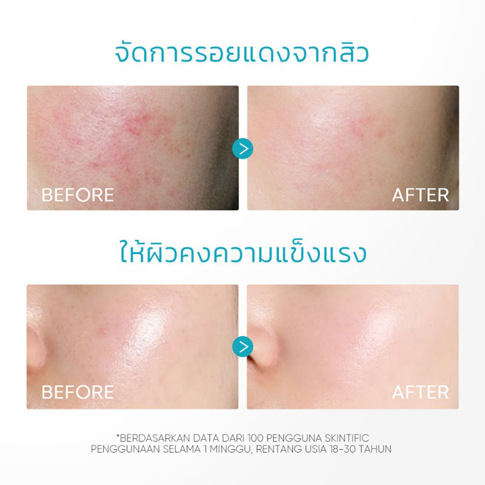 ครีมบำรุงผิวหน้า Skintific  5% Panthenol Acne Calming Water Gel